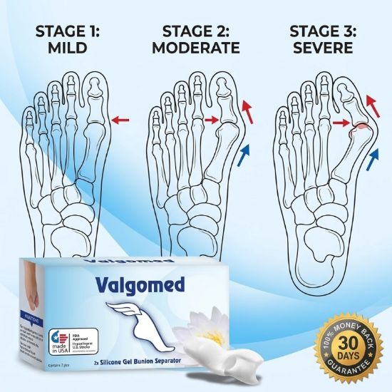 Picture of Valgomed 2x Silicone Gel Bunion Hallux Valgus Separator Fixative bales Toes