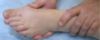 Picture of Valgomed 2x Silicone Gel Bunion Hallux Valgus Separator Fixative bales Toes